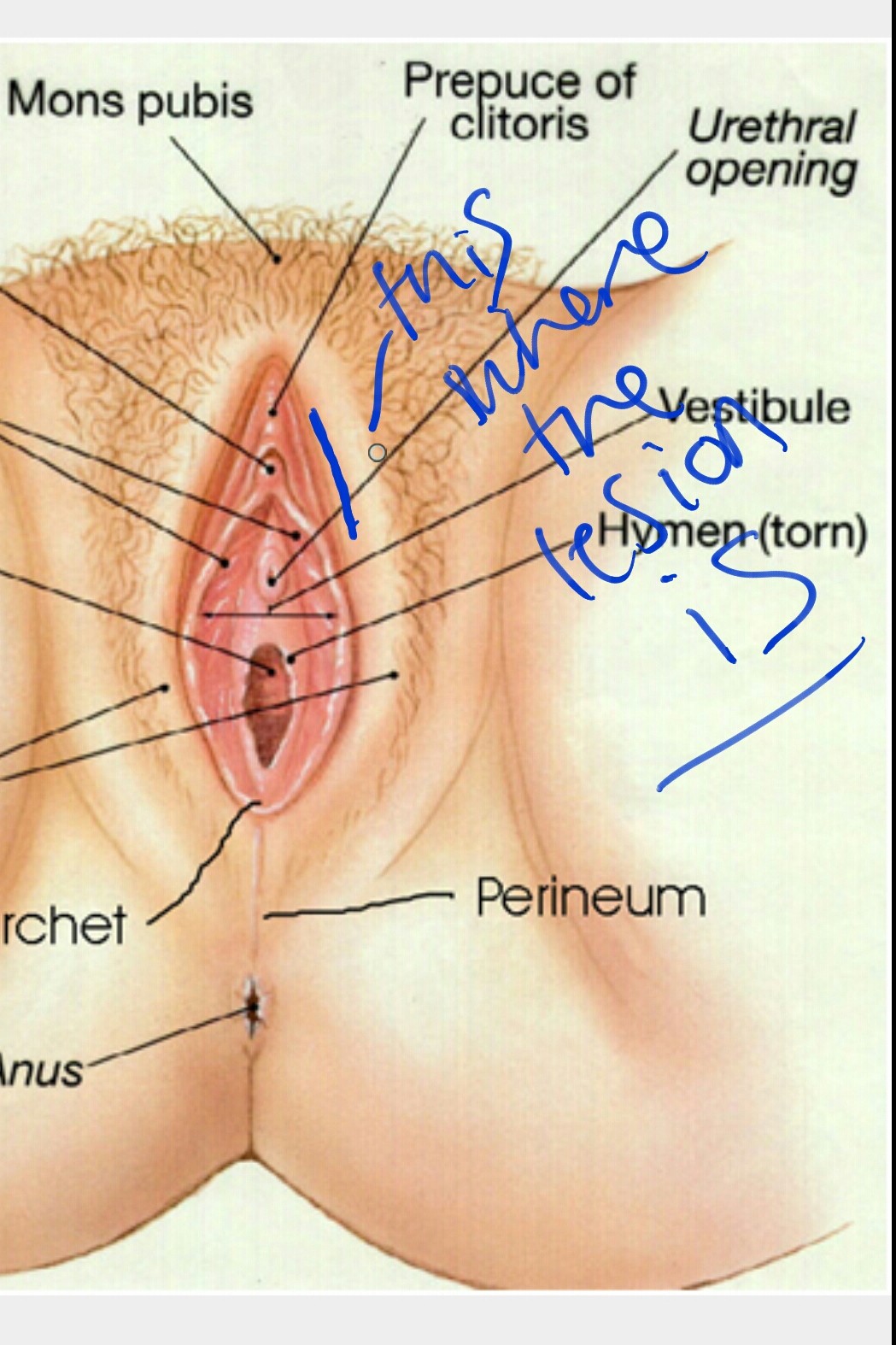 genital herpes looks like #9